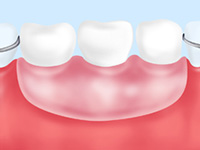入れ歯（保険適用）治療
